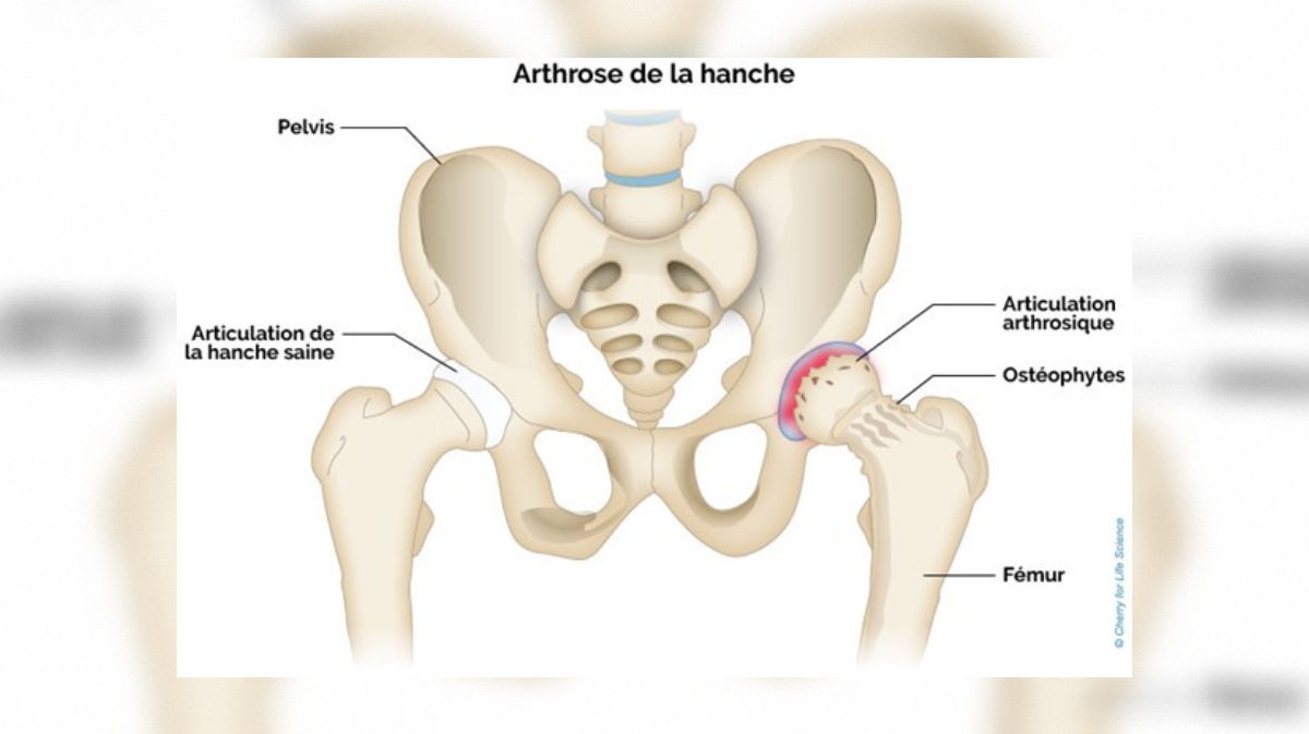 Arthrose de la hanche