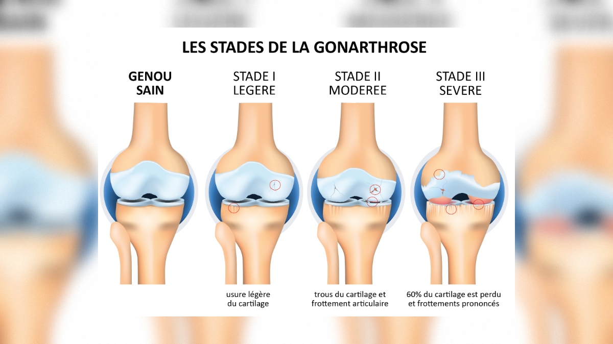 Arthrose du genou